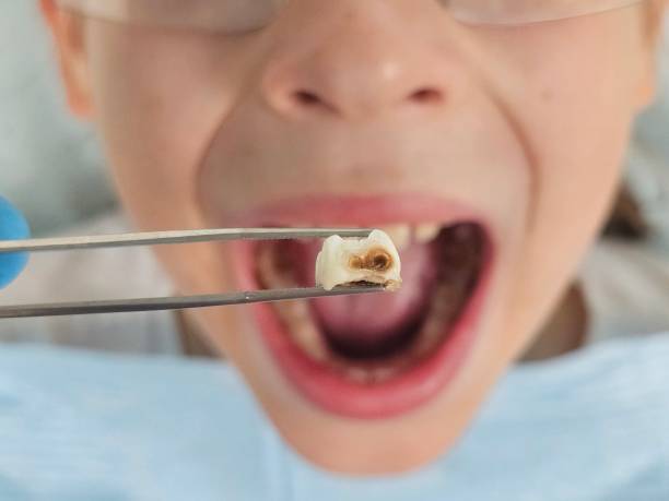 Best Emergency Dental Care for Broken or Chipped Teeth in Mount Washington, KY
